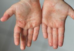 افزایش موارد ابتلا به سرخک در خوزستان در ماه‌های اخیر