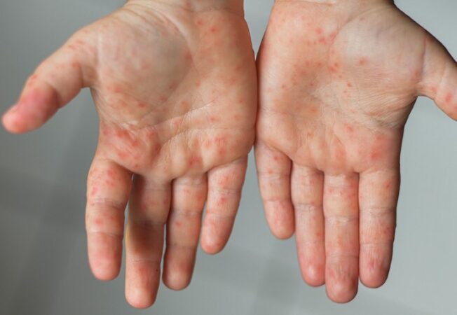 افزایش موارد ابتلا به سرخک در خوزستان در ماه‌های اخیر